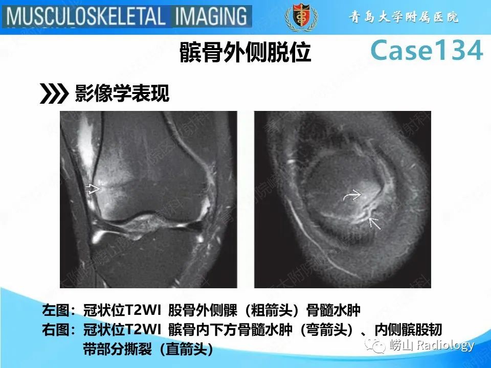 影像PPT - 【PPT】髌骨外侧脱位-11