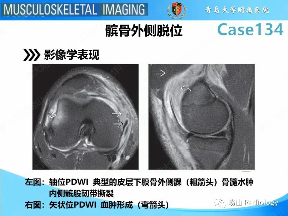 影像PPT - 【PPT】髌骨外侧脱位-12