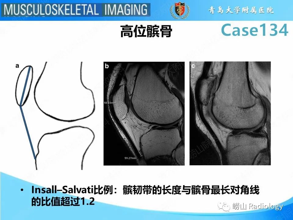 影像PPT - 【PPT】髌骨外侧脱位-17