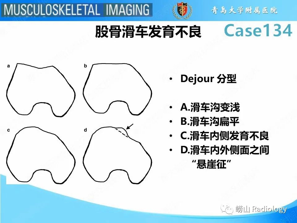 影像PPT - 【PPT】髌骨外侧脱位-19