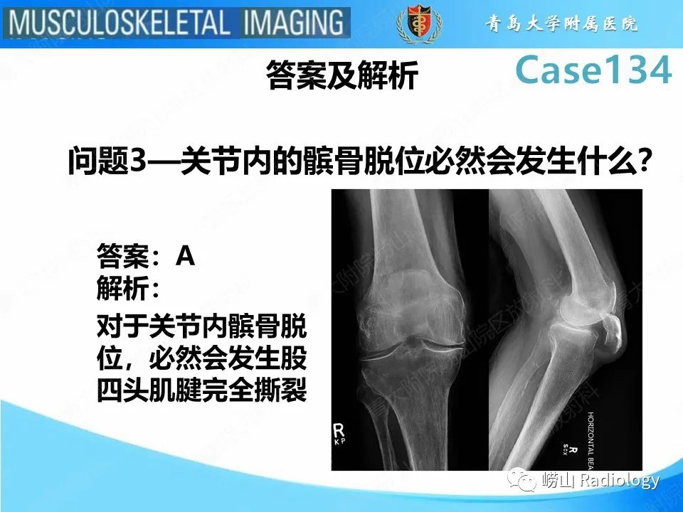 影像PPT - 【PPT】髌骨外侧脱位-14