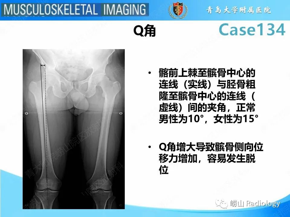 影像PPT - 【PPT】髌骨外侧脱位-18
