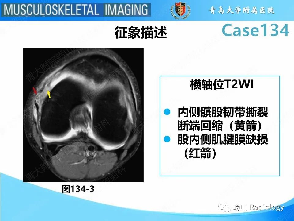 影像PPT - 【PPT】髌骨外侧脱位-22