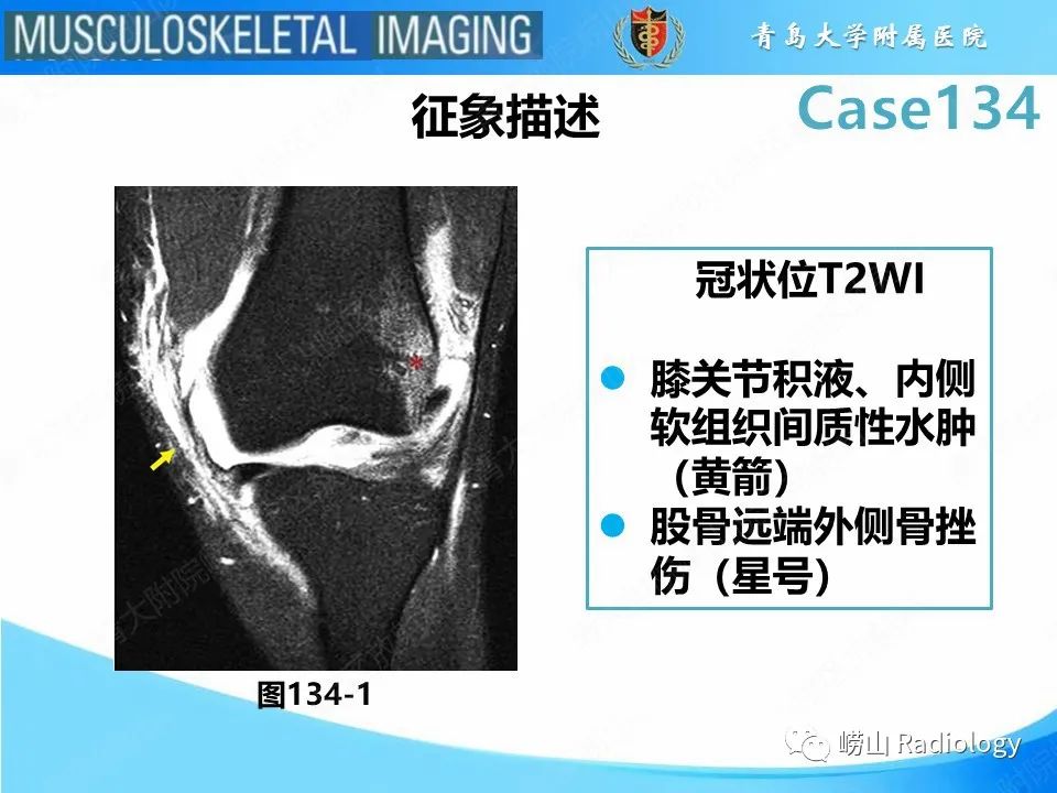 影像PPT - 【PPT】髌骨外侧脱位-20