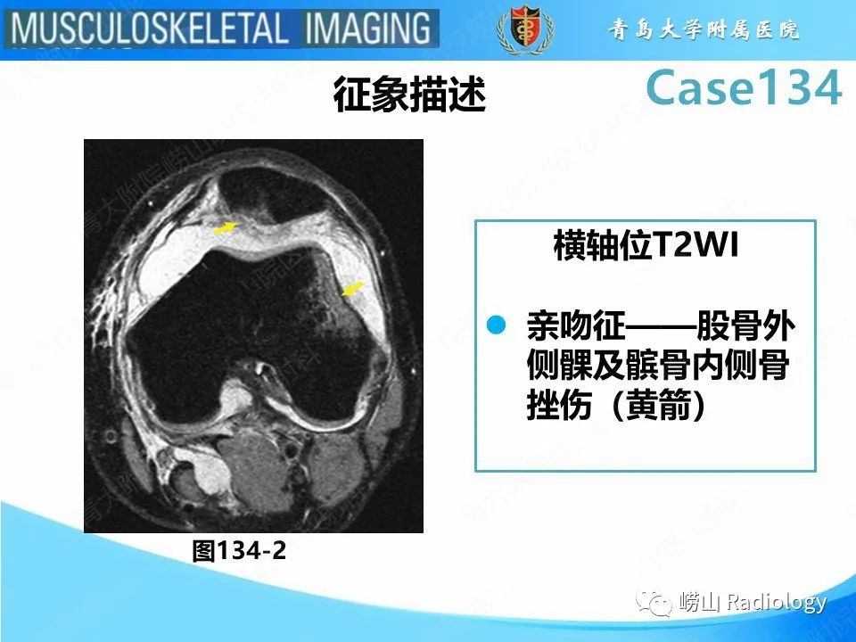 影像PPT - 【PPT】髌骨外侧脱位-21