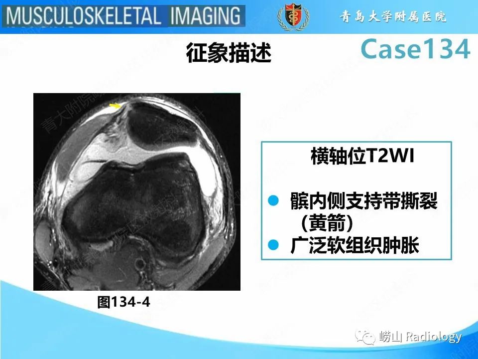 影像PPT - 【PPT】髌骨外侧脱位-23