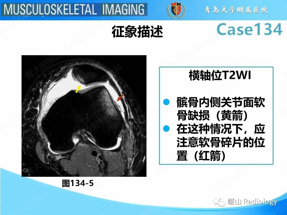 影像PPT - 【PPT】髌骨外侧脱位-24