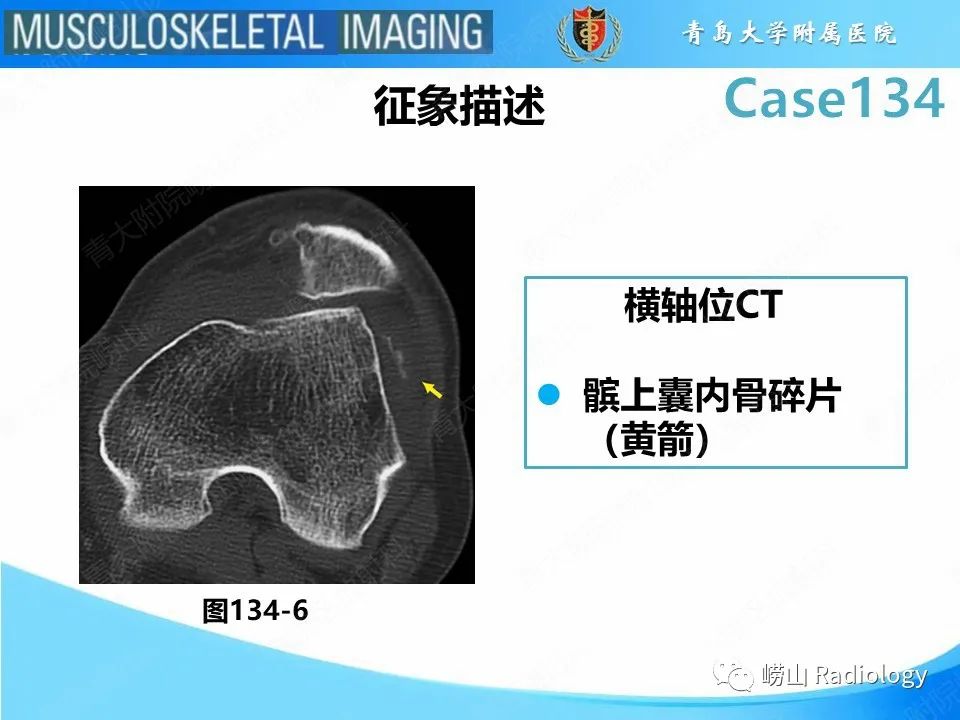 影像PPT - 【PPT】髌骨外侧脱位-25