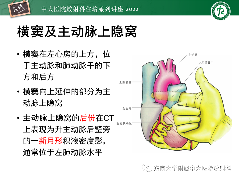 影像PPT - 【PPT】心包隐窝的CT解剖及在肿瘤影像检查中的临床意义-6