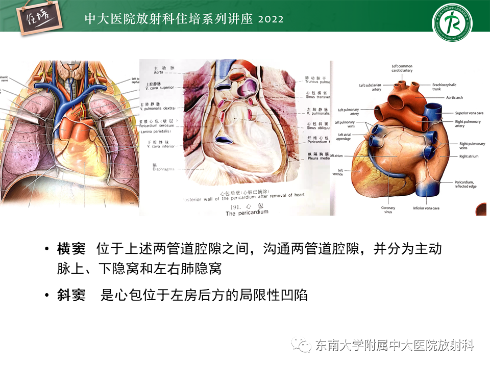 影像PPT - 【PPT】心包隐窝的CT解剖及在肿瘤影像检查中的临床意义-4