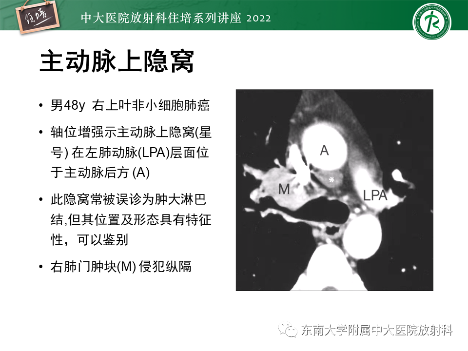 影像PPT - 【PPT】心包隐窝的CT解剖及在肿瘤影像检查中的临床意义-7