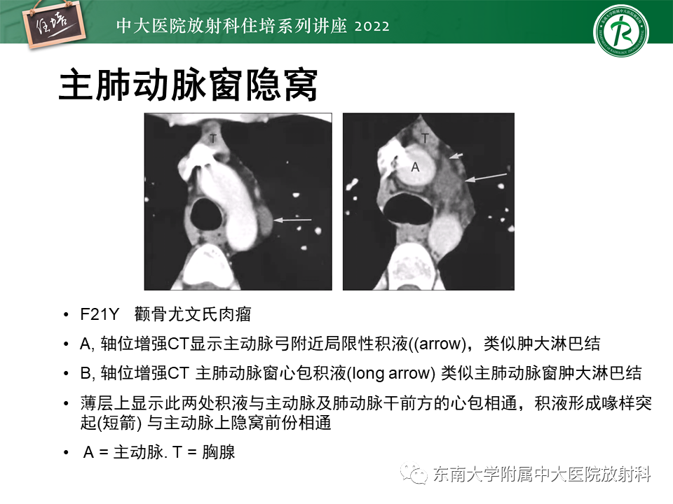 影像PPT - 【PPT】心包隐窝的CT解剖及在肿瘤影像检查中的临床意义-10