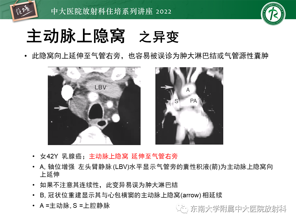 影像PPT - 【PPT】心包隐窝的CT解剖及在肿瘤影像检查中的临床意义-8