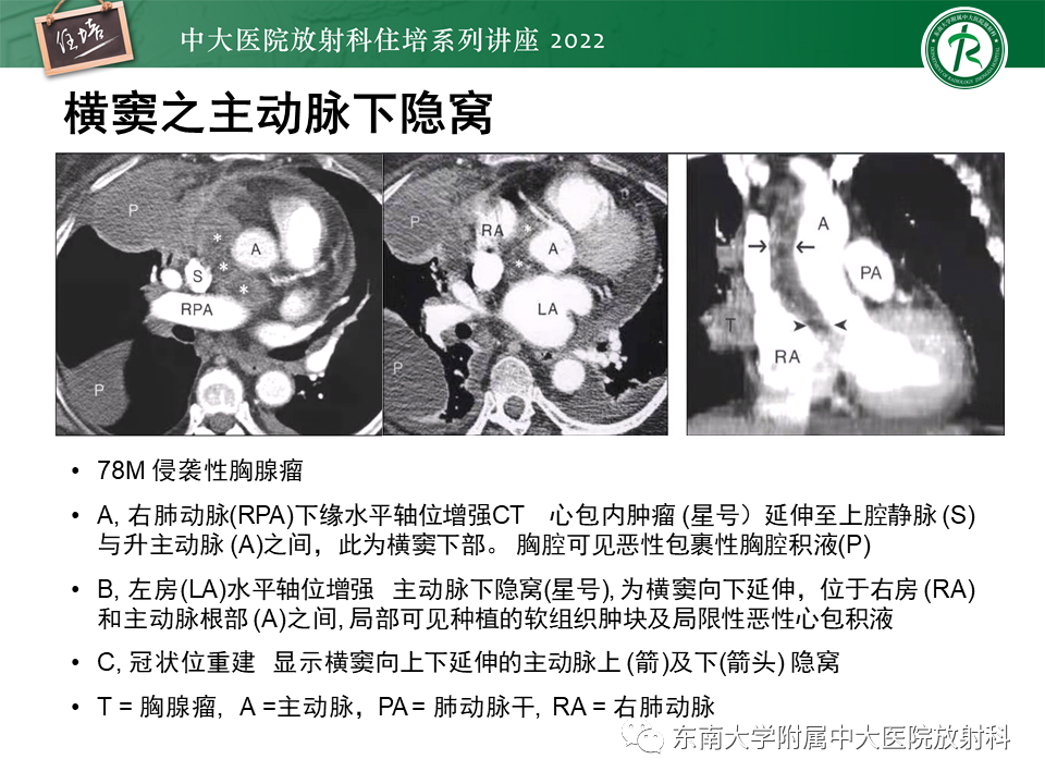 影像PPT - 【PPT】心包隐窝的CT解剖及在肿瘤影像检查中的临床意义-12