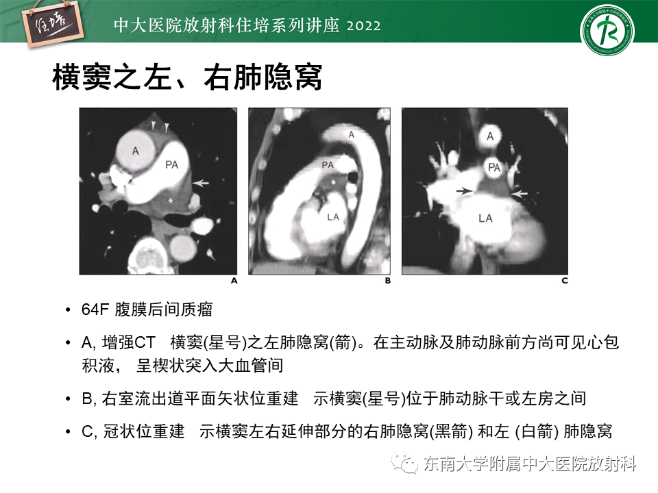 影像PPT - 【PPT】心包隐窝的CT解剖及在肿瘤影像检查中的临床意义-14