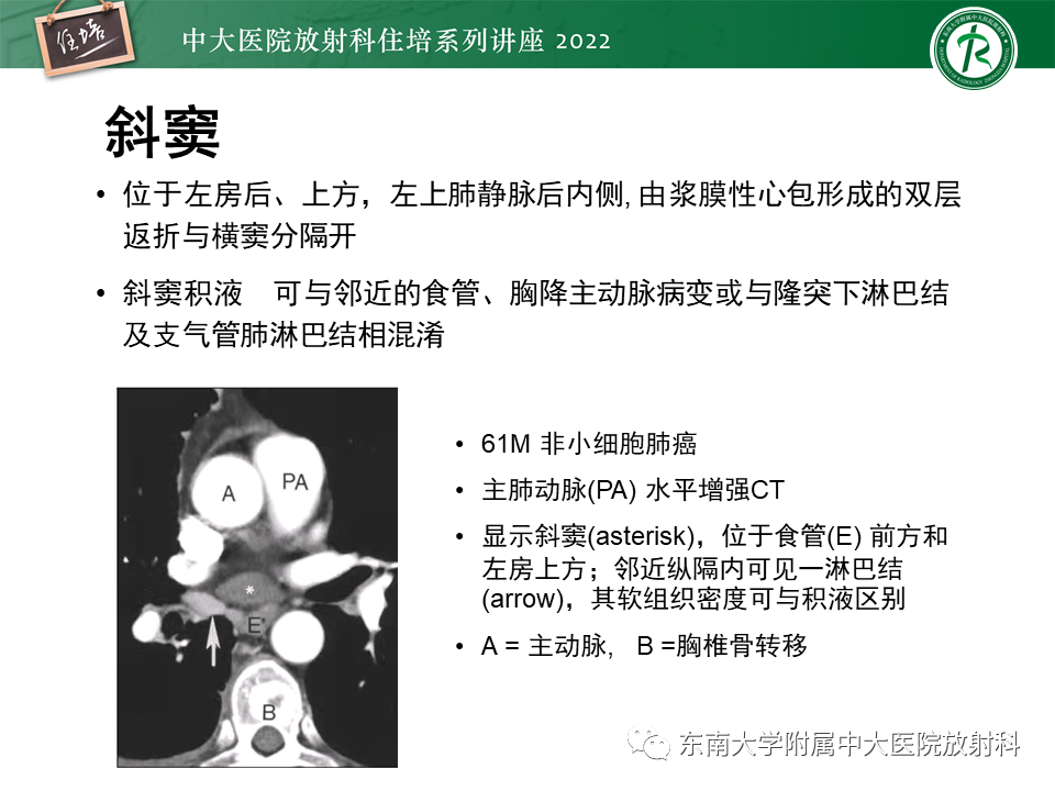 影像PPT - 【PPT】心包隐窝的CT解剖及在肿瘤影像检查中的临床意义-16
