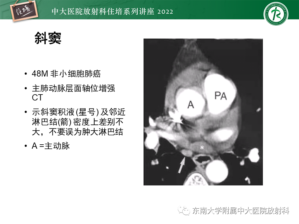 影像PPT - 【PPT】心包隐窝的CT解剖及在肿瘤影像检查中的临床意义-17