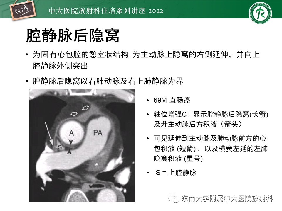影像PPT - 【PPT】心包隐窝的CT解剖及在肿瘤影像检查中的临床意义-15