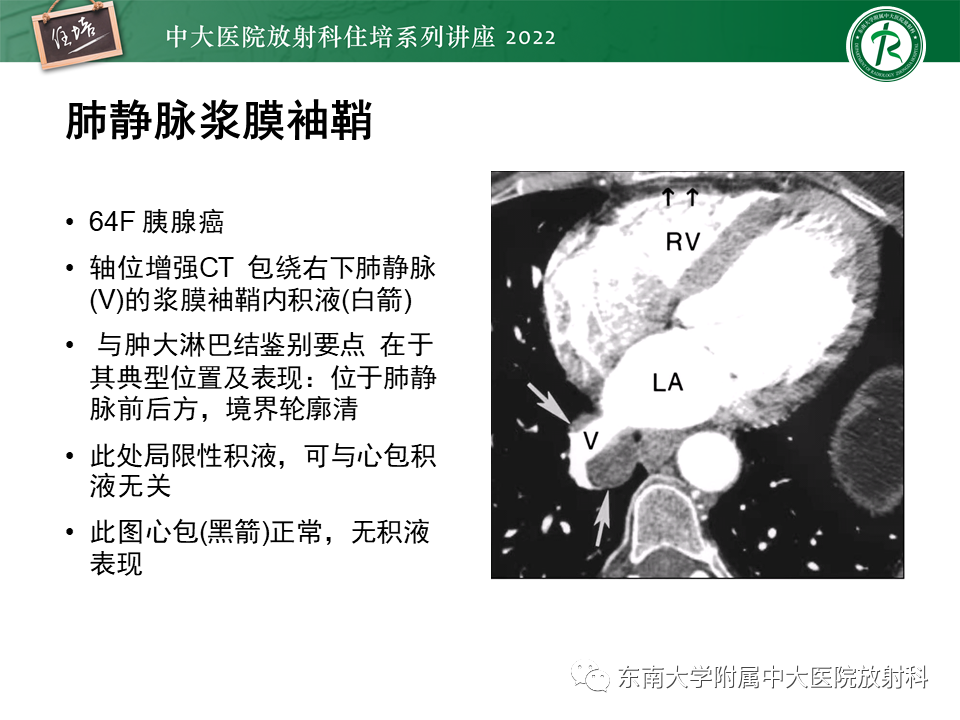 影像PPT - 【PPT】心包隐窝的CT解剖及在肿瘤影像检查中的临床意义-20