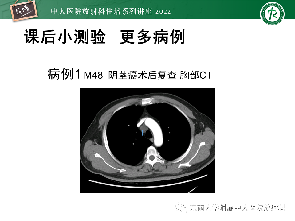 影像PPT - 【PPT】心包隐窝的CT解剖及在肿瘤影像检查中的临床意义-22