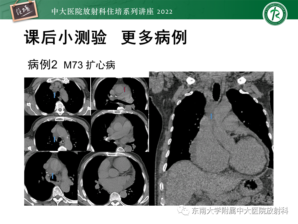 影像PPT - 【PPT】心包隐窝的CT解剖及在肿瘤影像检查中的临床意义-23