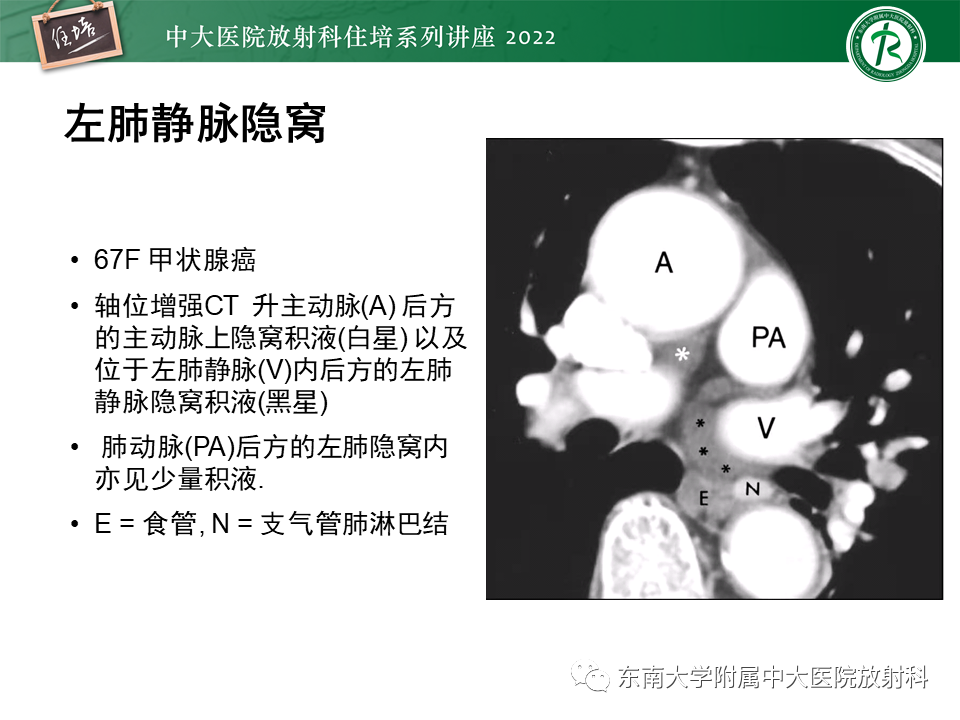 影像PPT - 【PPT】心包隐窝的CT解剖及在肿瘤影像检查中的临床意义-19