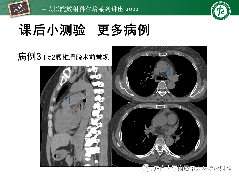 影像PPT - 【PPT】心包隐窝的CT解剖及在肿瘤影像检查中的临床意义-24