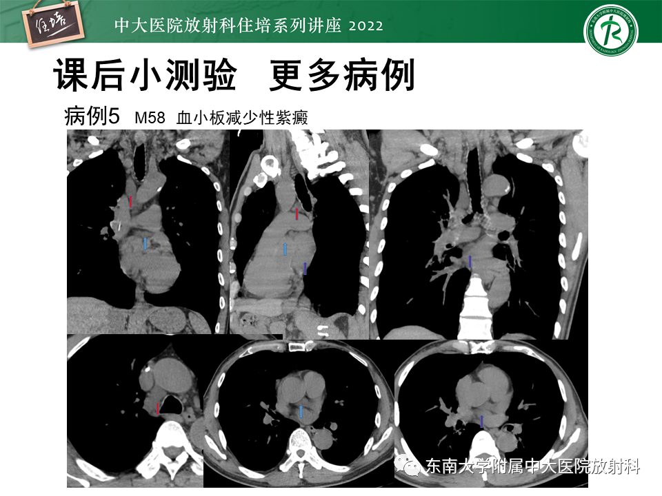 影像PPT - 【PPT】心包隐窝的CT解剖及在肿瘤影像检查中的临床意义-26