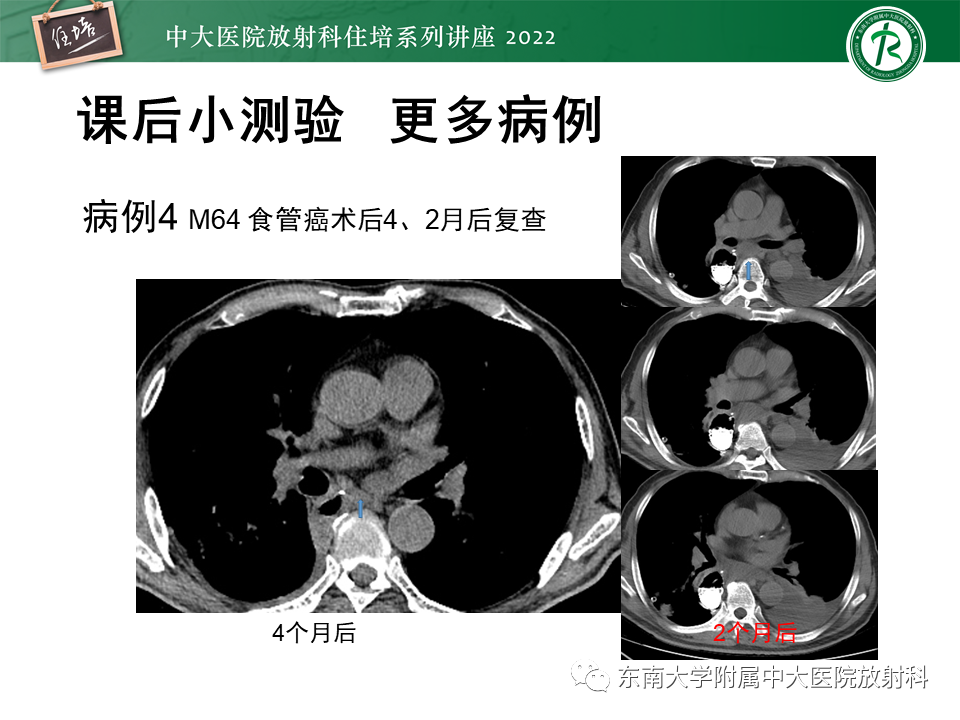 影像PPT - 【PPT】心包隐窝的CT解剖及在肿瘤影像检查中的临床意义-25