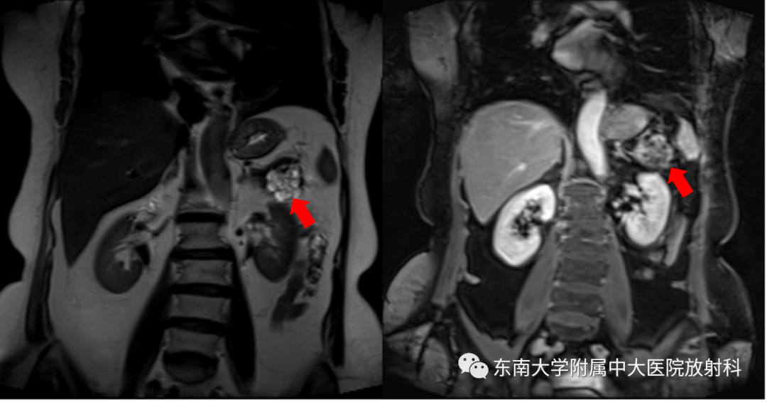 影像PPT - 【PPT】胰腺常见囊性病变影像表现-3