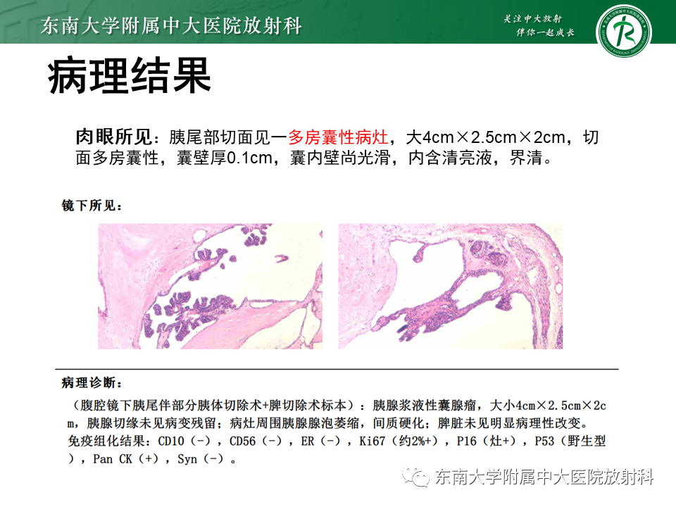 影像PPT - 【PPT】胰腺常见囊性病变影像表现-4