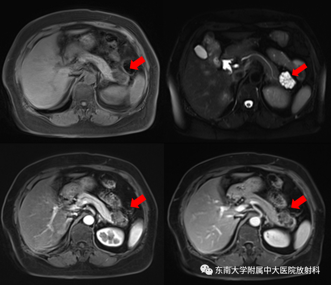 影像PPT - 【PPT】胰腺常见囊性病变影像表现-2