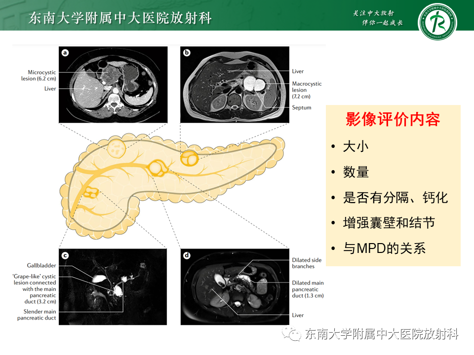影像PPT - 【PPT】胰腺常见囊性病变影像表现-11