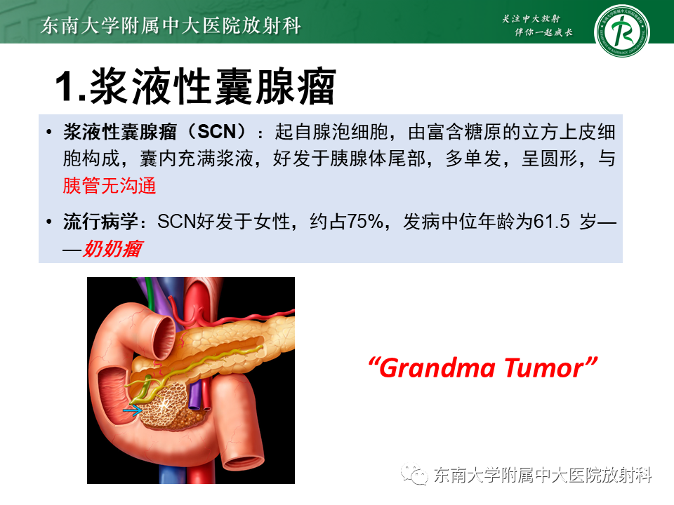 影像PPT - 【PPT】胰腺常见囊性病变影像表现-17
