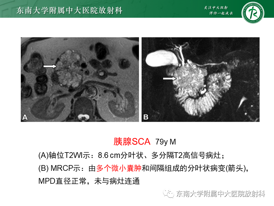 影像PPT - 【PPT】胰腺常见囊性病变影像表现-19