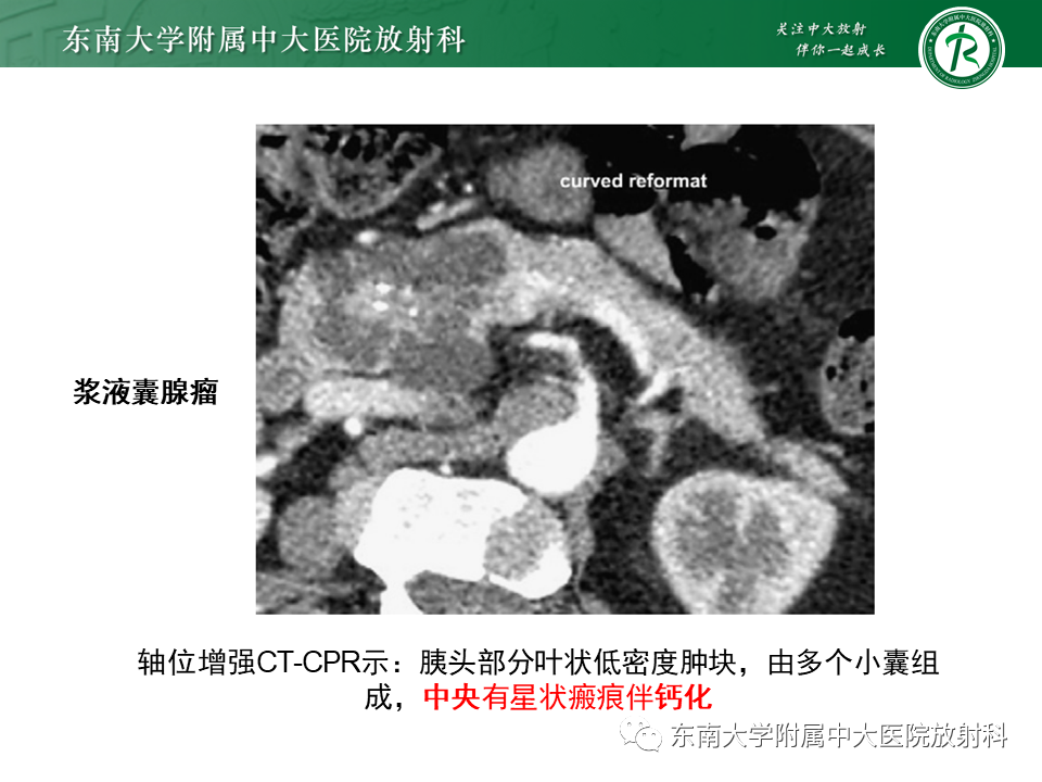 影像PPT - 【PPT】胰腺常见囊性病变影像表现-20