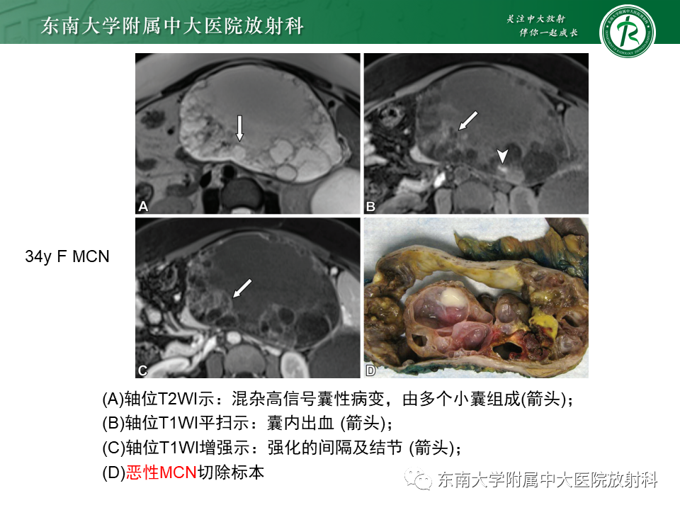 影像PPT - 【PPT】胰腺常见囊性病变影像表现-24