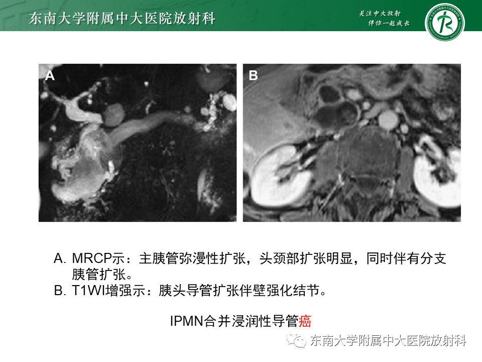 影像PPT - 【PPT】胰腺常见囊性病变影像表现-28