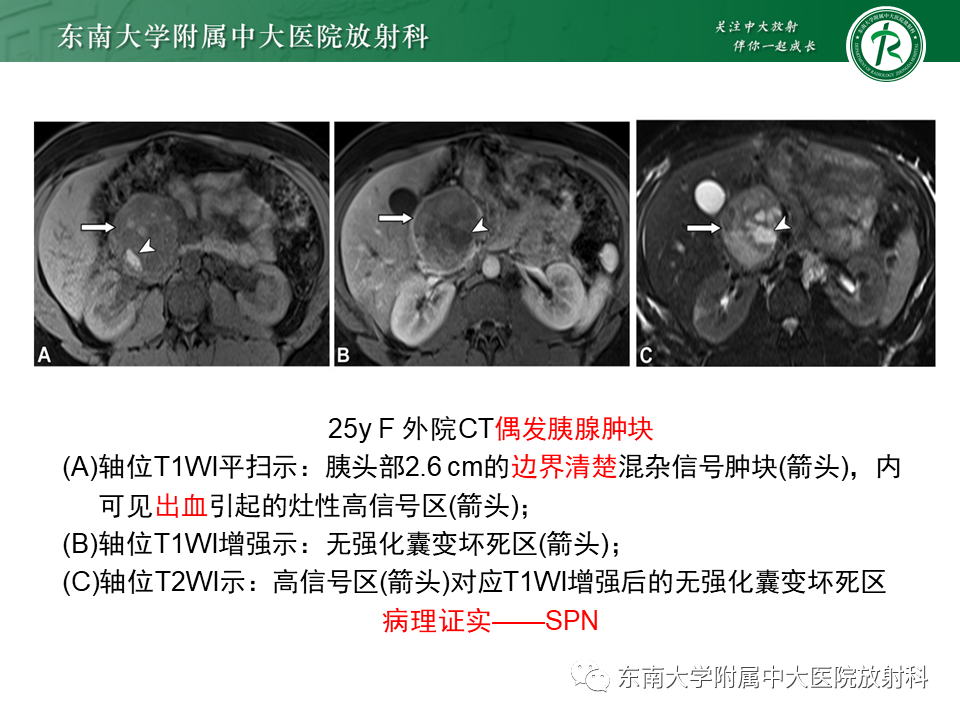 影像PPT - 【PPT】胰腺常见囊性病变影像表现-32