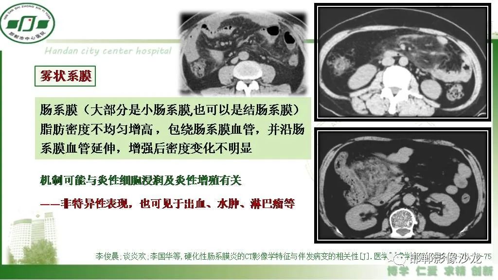 影像PPT - 【PPT】硬化性肠系膜炎-12