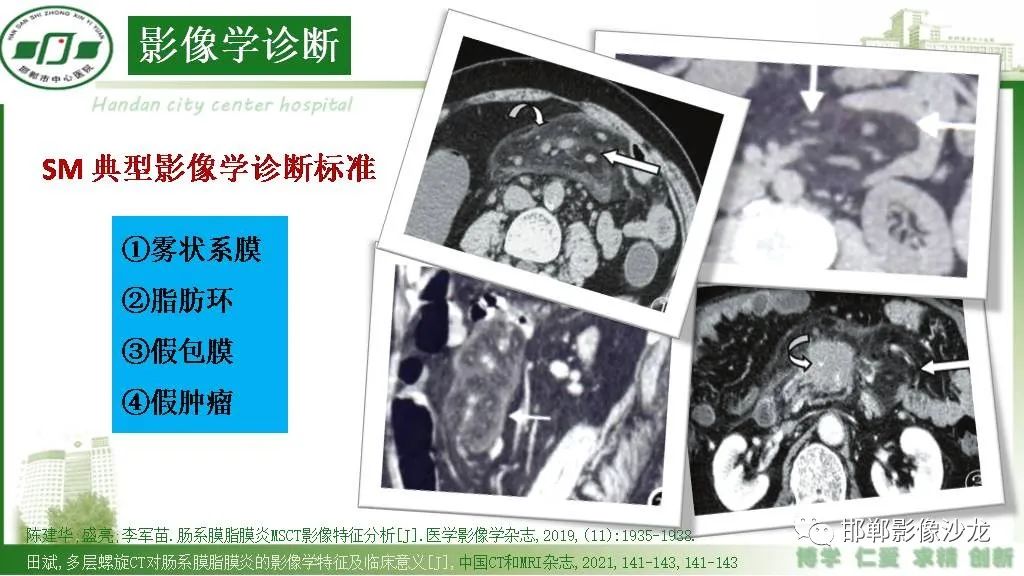 影像PPT - 【PPT】硬化性肠系膜炎-11