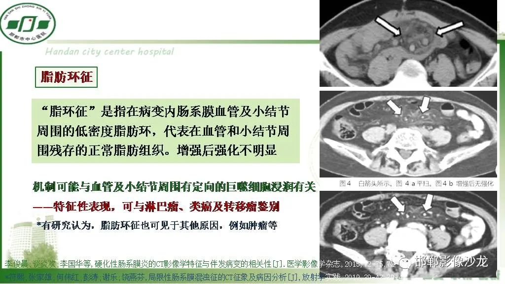 影像PPT - 【PPT】硬化性肠系膜炎-13