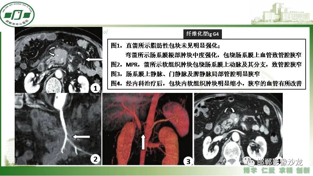 影像PPT - 【PPT】硬化性肠系膜炎-18
