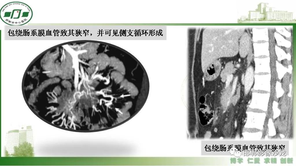 影像PPT - 【PPT】硬化性肠系膜炎-19