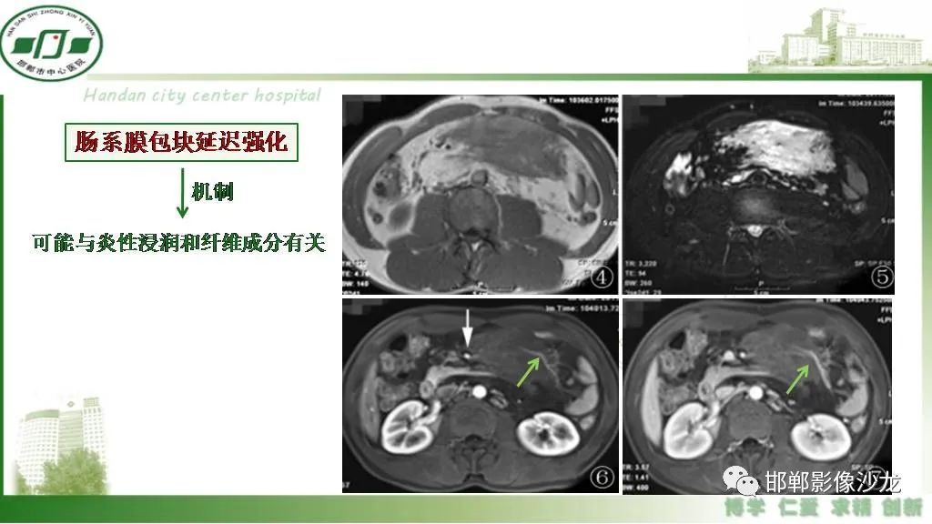 影像PPT - 【PPT】硬化性肠系膜炎-22