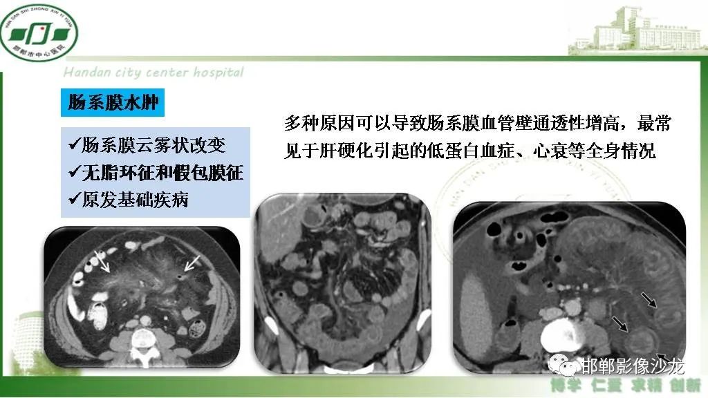 影像PPT - 【PPT】硬化性肠系膜炎-24
