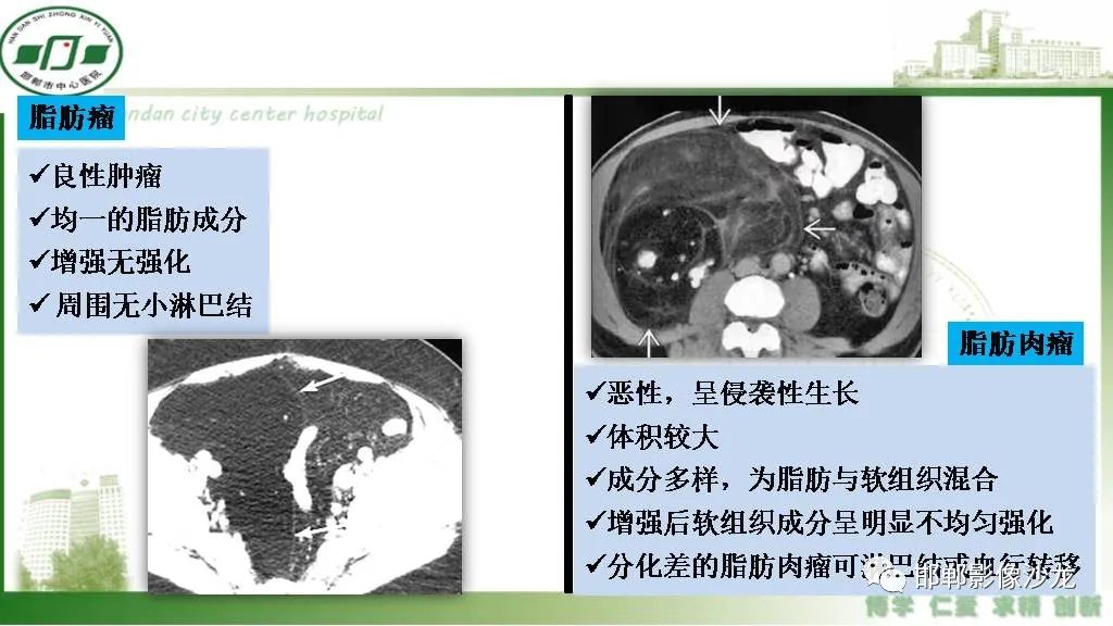 影像PPT - 【PPT】硬化性肠系膜炎-27