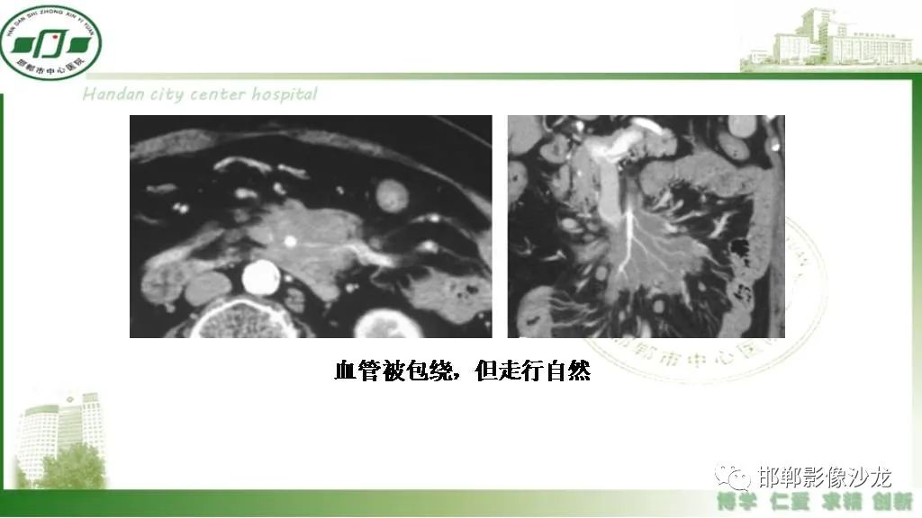 影像PPT - 【PPT】硬化性肠系膜炎-29