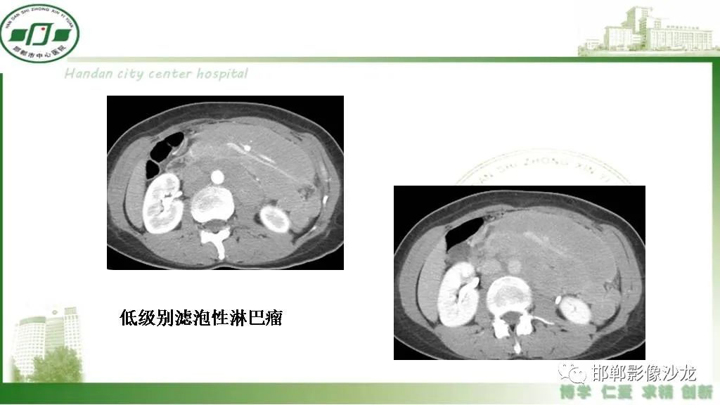 影像PPT - 【PPT】硬化性肠系膜炎-30