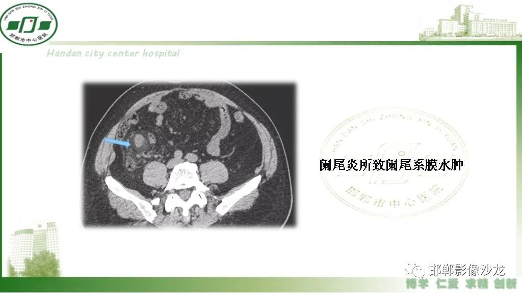 影像PPT - 【PPT】硬化性肠系膜炎-36